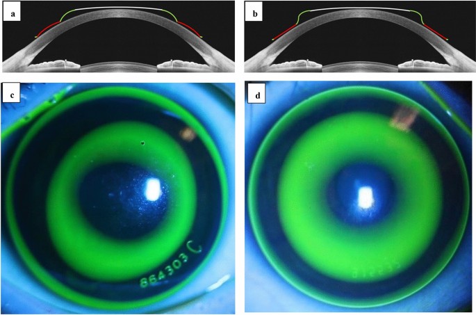 Orthokeratology-Therapy